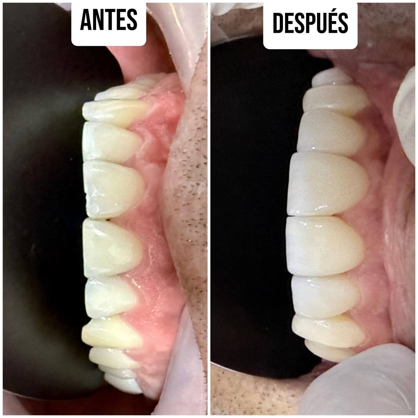 Antes y después de tratamiento odontológico digital