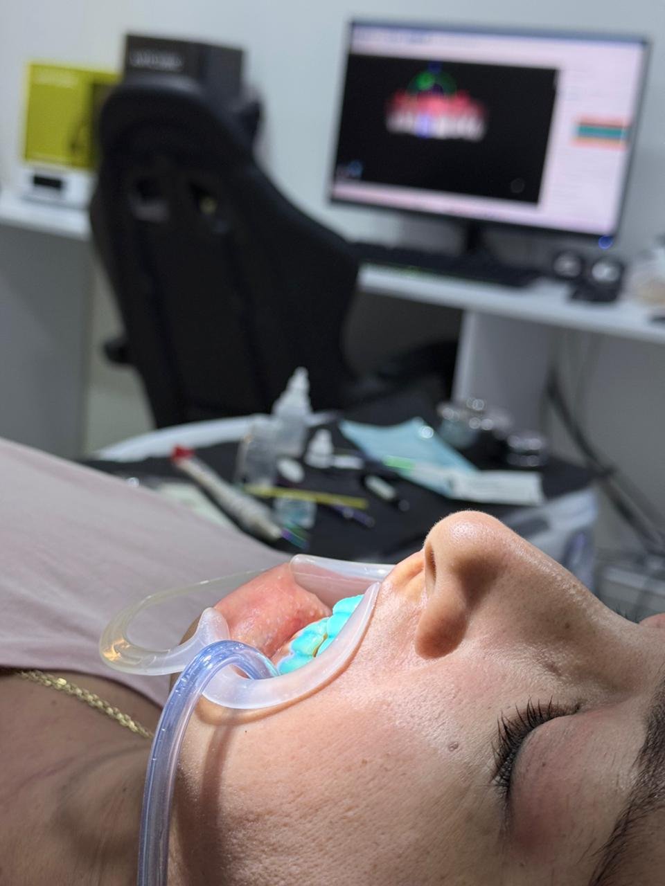 Blanqueamiento dental guiado por flujo digital